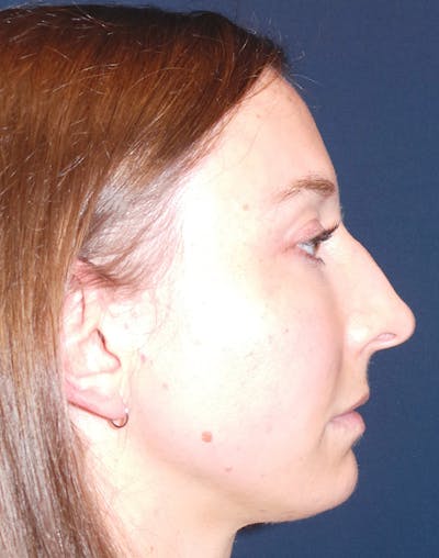 Rhinoplasty by Dr. Booth Before & After Gallery - Patient 102709360 - Image 1