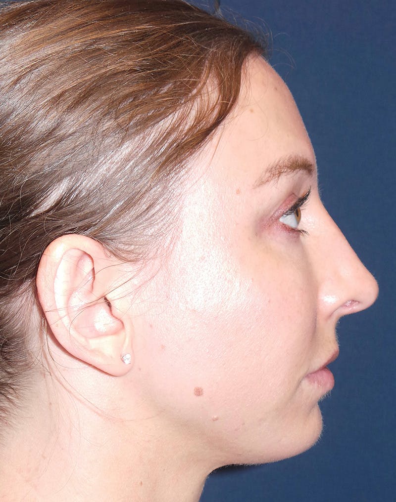 Rhinoplasty by Dr. Booth Before & After Gallery - Patient 102709360 - Image 2