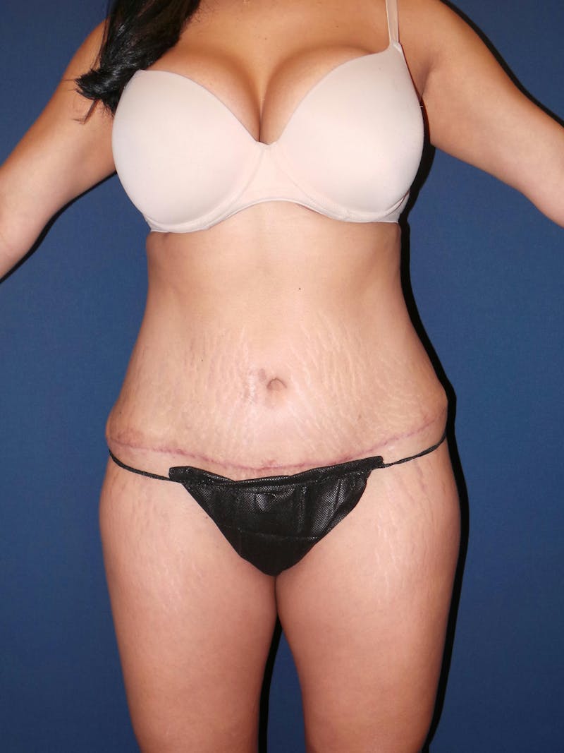 Patient 176763660  Tummy Tuck Revision by Dr. Booth Before