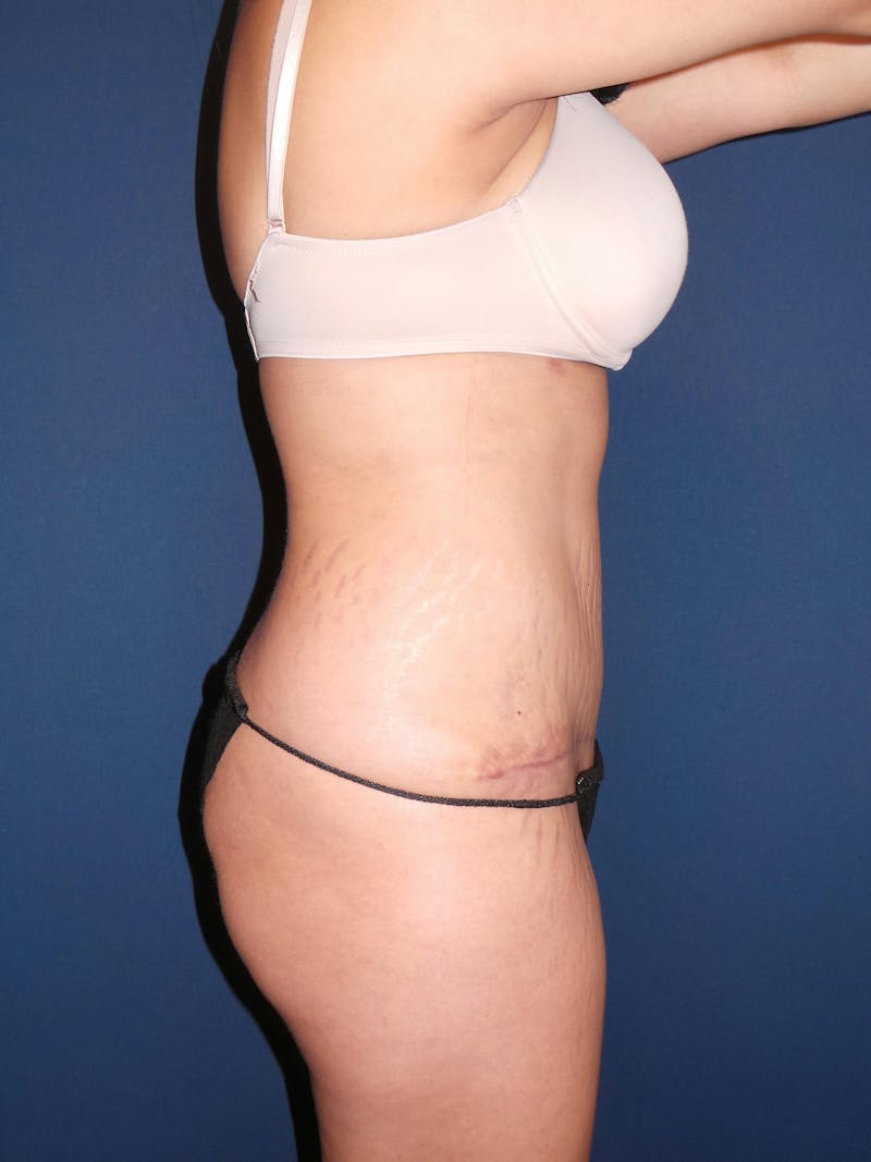 Liposuction by Dr. Booth Before & After Gallery - Patient 176763704 - Image 3