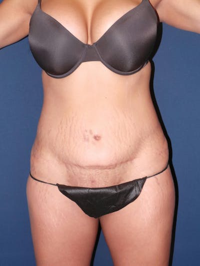 Tummy Tuck Revision by Dr. Booth Before & After Gallery - Patient 176763660 - Image 1