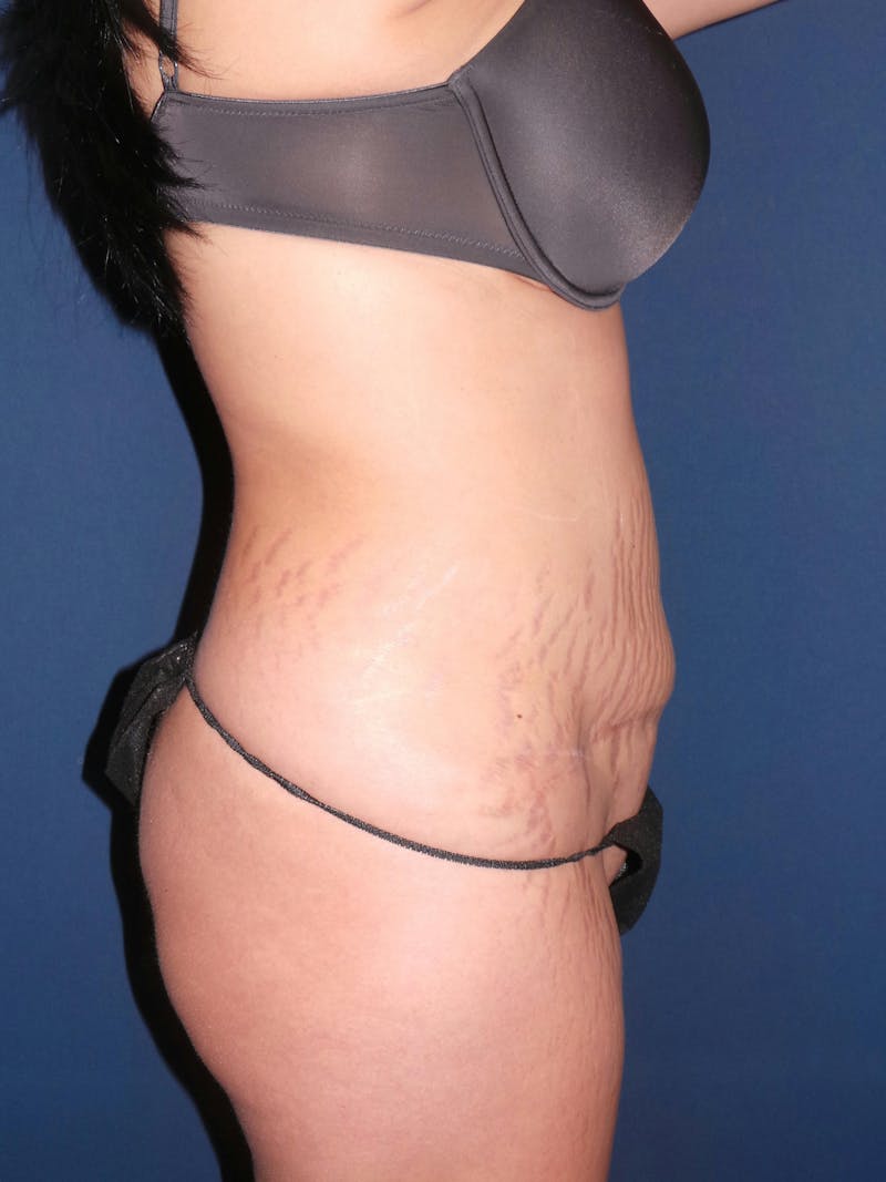 Liposuction by Dr. Booth Before & After Gallery - Patient 176763704 - Image 4