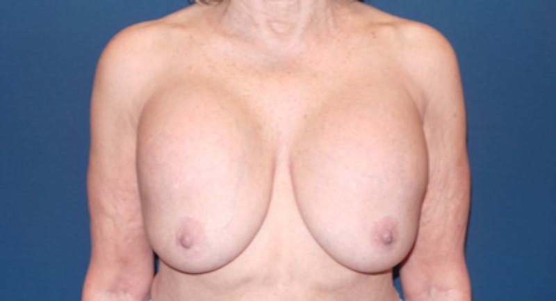  Breast Lift with Implant Exchange Dr. Booth Before & After Gallery - Patient 182122393 - Image 3