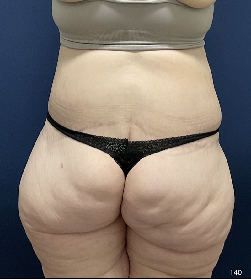 Liposuction by Dr. Haydon Before & After Gallery - Patient 191019025 - Image 6
