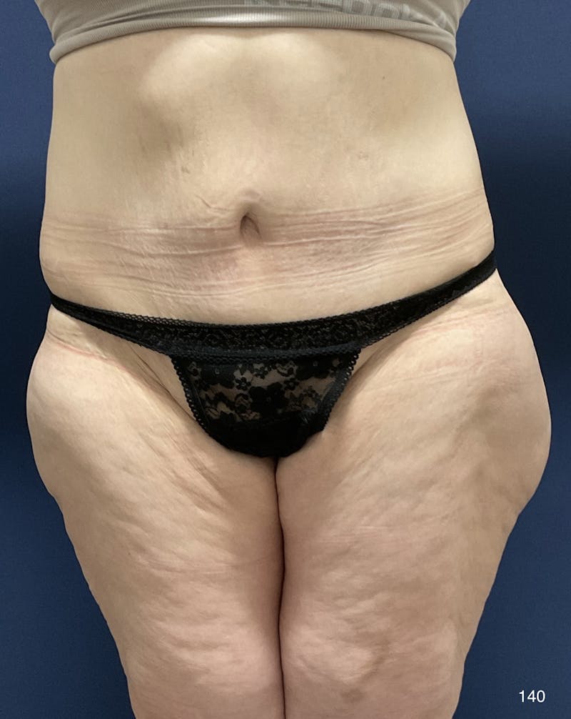 Liposuction by Dr. Haydon Before & After Gallery - Patient 191019025 - Image 2