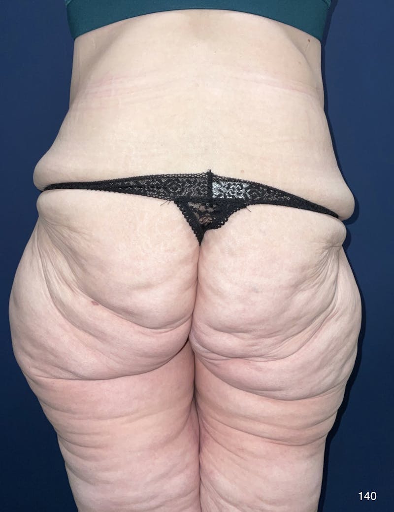 Liposuction by Dr. Haydon Before & After Gallery - Patient 191019025 - Image 5
