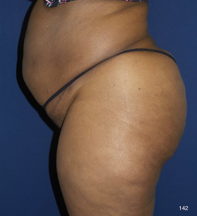 Tummy Tuck by Dr. Haydon Before & After Gallery - Patient 191019043 - Image 3
