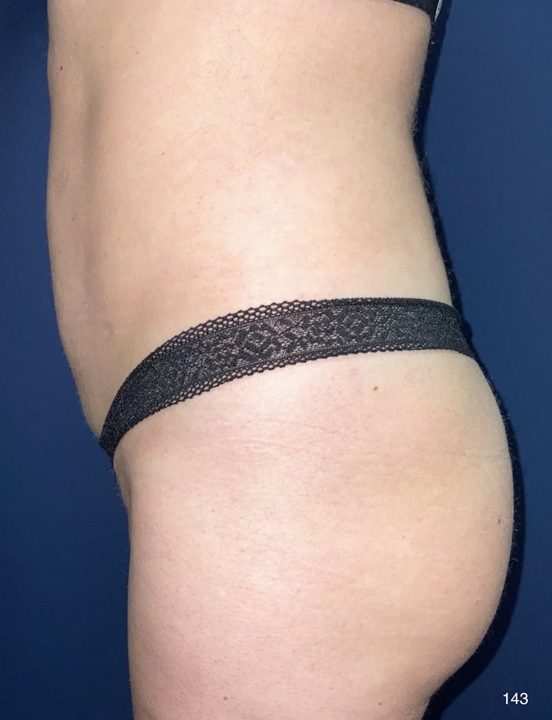 Liposuction by Dr. Haydon Before & After Gallery - Patient 191019052 - Image 3