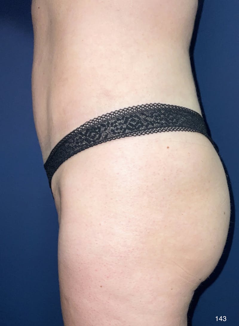 Liposuction by Dr. Haydon Before & After Gallery - Patient 191019052 - Image 4