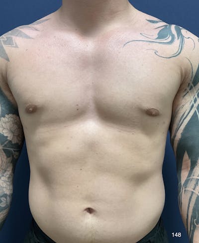 Gynecomastia by Dr. Haydon Before & After Gallery - Patient 191023094 - Image 2