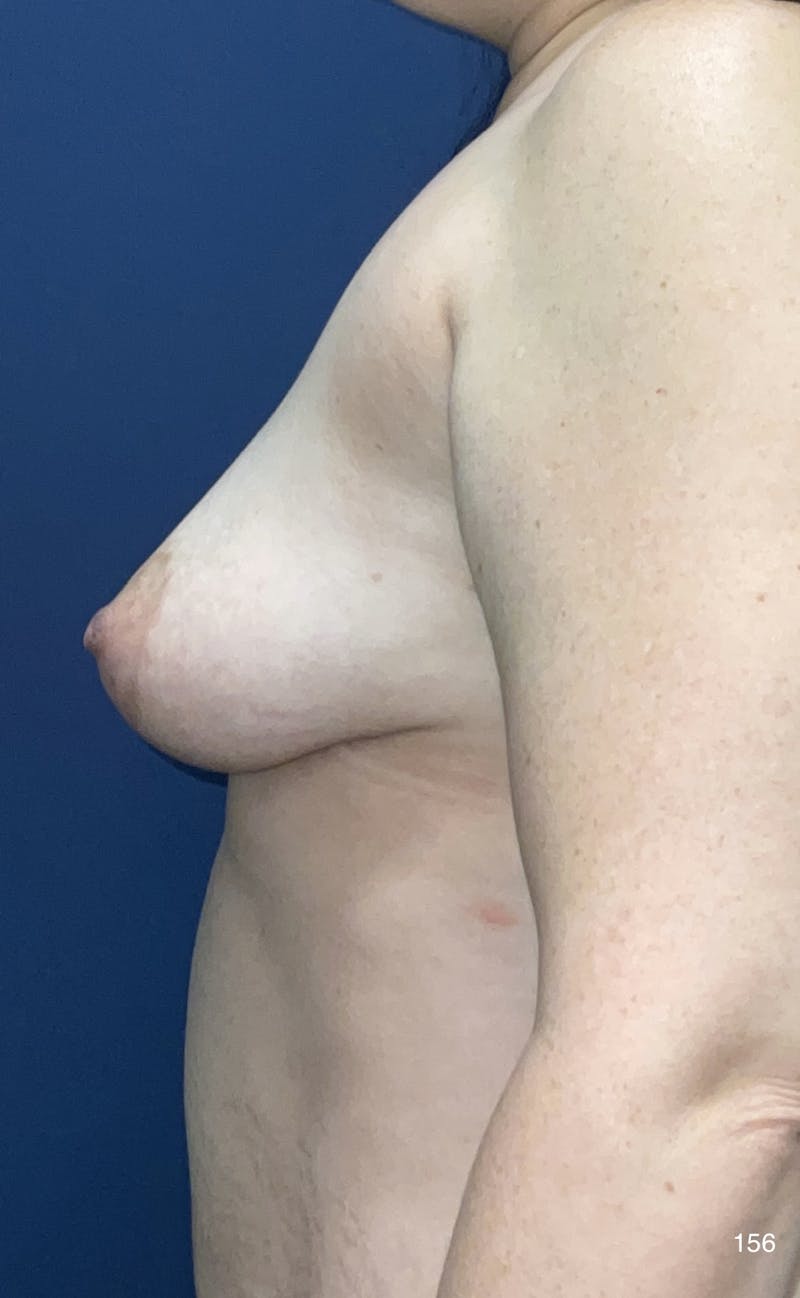 Fat Transfer by Dr. Haydon Before & After Gallery - Patient 191023327 - Image 4