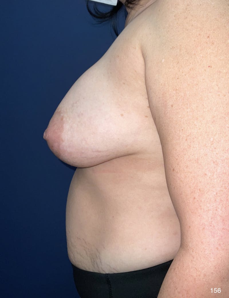 Liposuction by Dr. Haydon Before & After Gallery - Patient 191023462 - Image 3