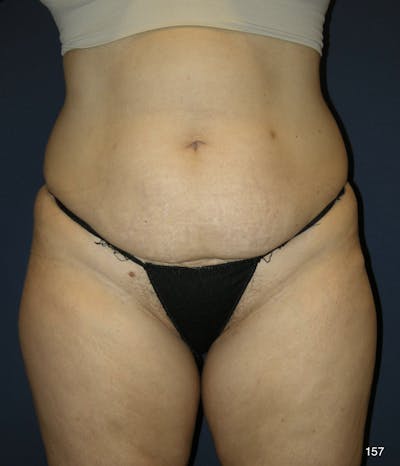 Tummy Tuck by Dr. Haydon Before & After Gallery - Patient 191023537 - Image 1