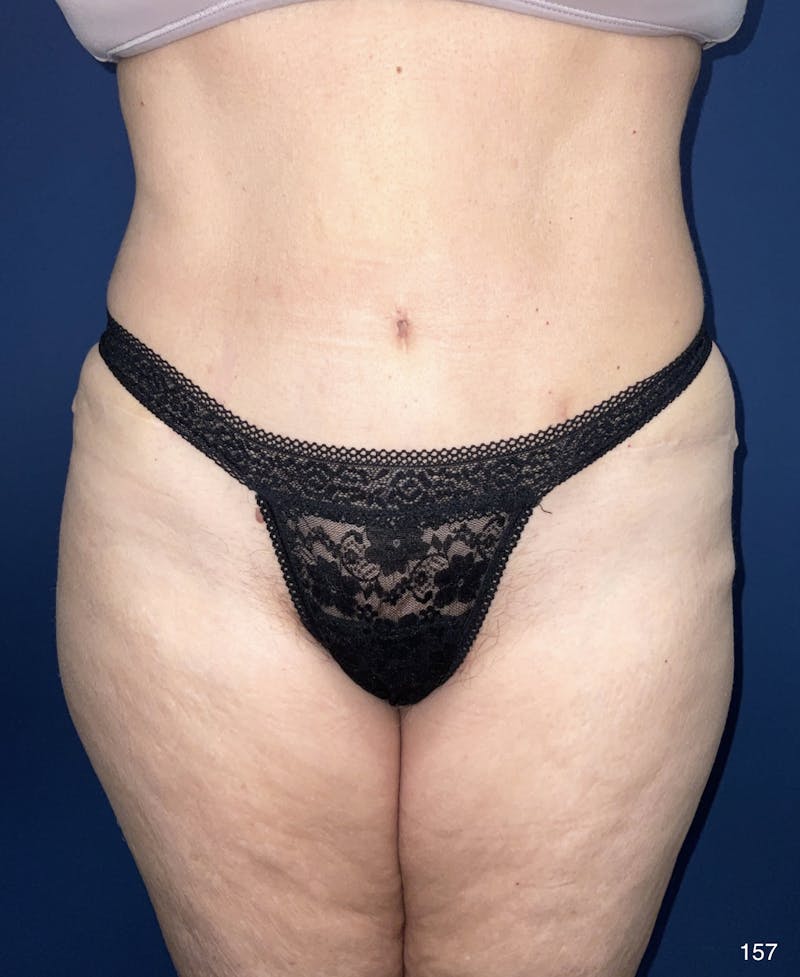 Liposuction by Dr. Haydon Before & After Gallery - Patient 191023538 - Image 2