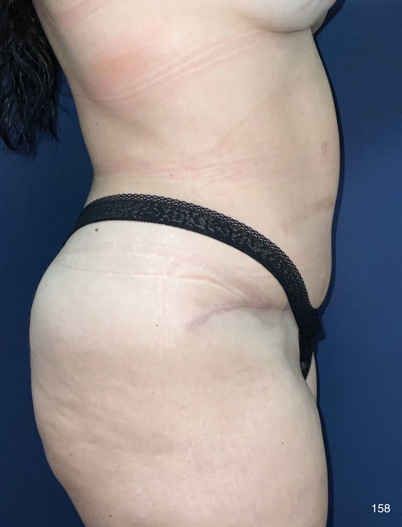Tummy Tuck by Dr. Haydon Before & After Gallery - Patient 191021338 - Image 6