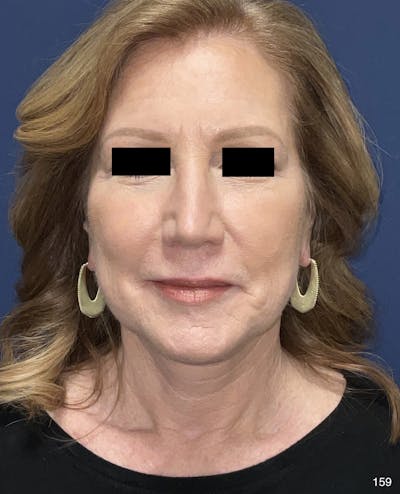 Neck Lift by Dr. Haydon Before & After Gallery - Patient 191023544 - Image 2