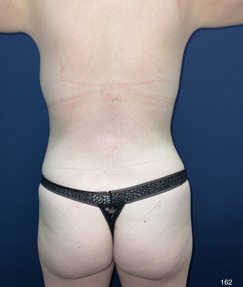 Tummy Tuck by Dr. Haydon Before & After Gallery - Patient 191023783 - Image 8