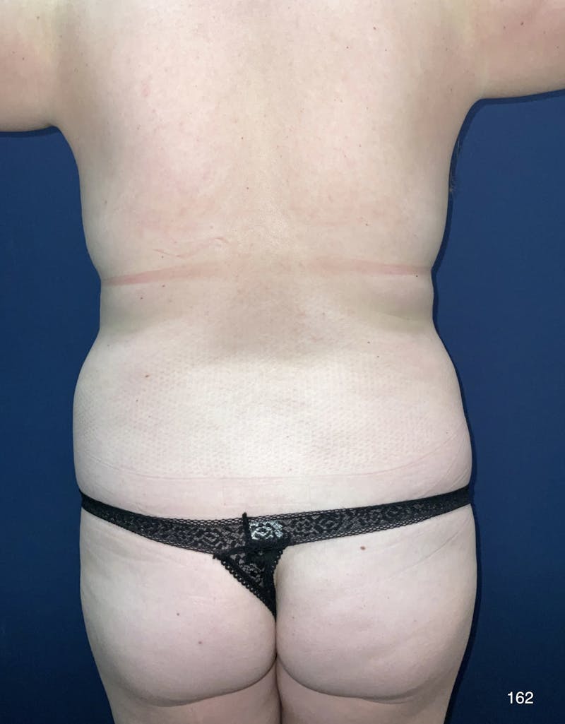 Tummy Tuck by Dr. Haydon Before & After Gallery - Patient 191023783 - Image 7