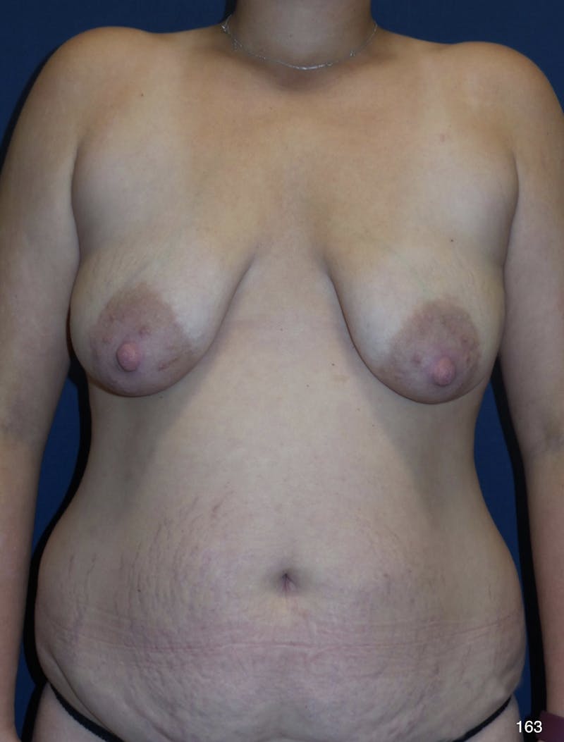 Liposuction by Dr. Haydon Before & After Gallery - Patient 191022408 - Image 1