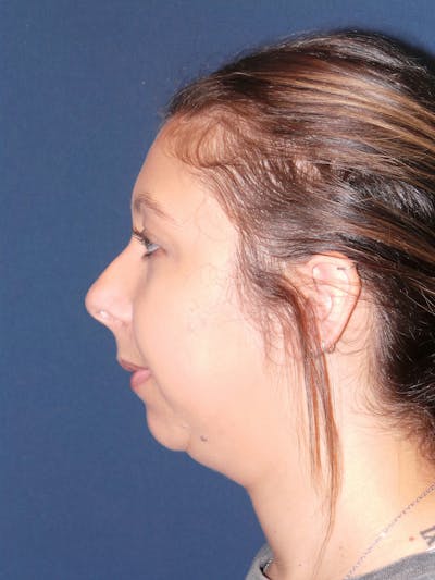 Chin Augmentation by Dr. Booth Before & After Gallery - Patient 192611166 - Image 1