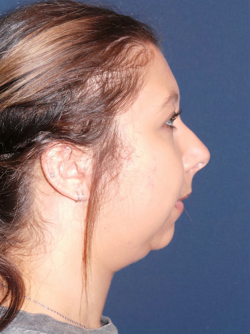 Chin Augmentation by Dr. Booth Before & After Gallery - Patient 192611166 - Image 7