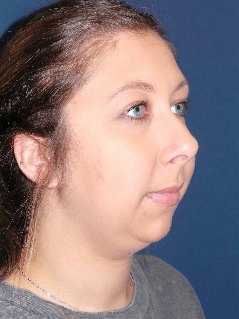 Chin Augmentation by Dr. Booth Before & After Gallery - Patient 192611166 - Image 9