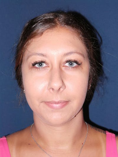 Buccal Fat Removal by Dr. Booth Before & After Gallery - Patient 192610999 - Image 2