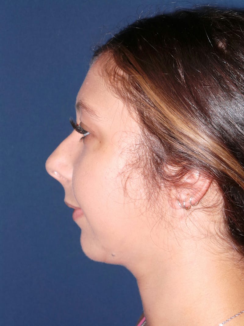 Buccal Fat Removal by Dr. Booth Before & After Gallery - Patient 192610999 - Image 6