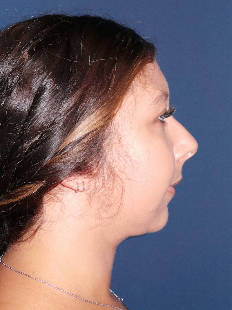 Buccal Fat Removal by Dr. Booth Before & After Gallery - Patient 192610999 - Image 8