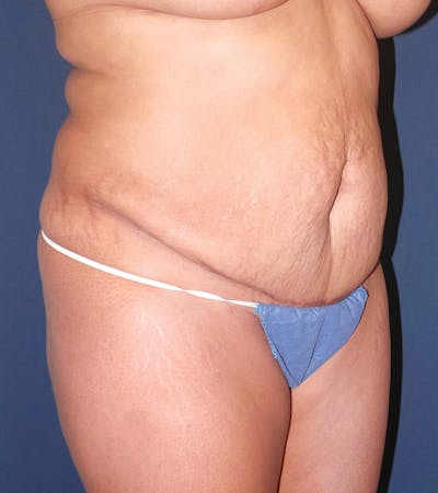 Tummy Tuck Revision by Dr. Booth Before & After Gallery - Patient 195854421 - Image 1