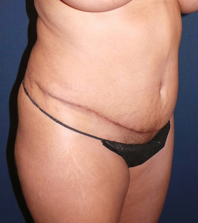 Tummy Tuck Revision by Dr. Booth Before & After Gallery - Patient 195854421 - Image 2