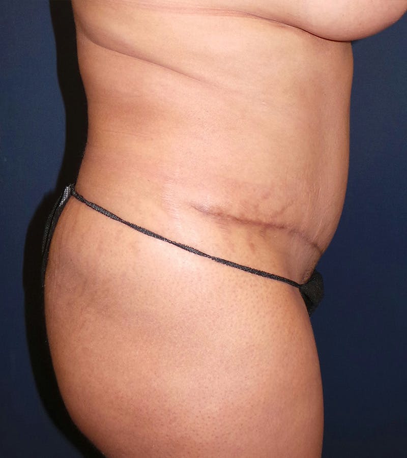 Tummy Tuck Revision by Dr. Booth Before & After Gallery - Patient 195854421 - Image 4