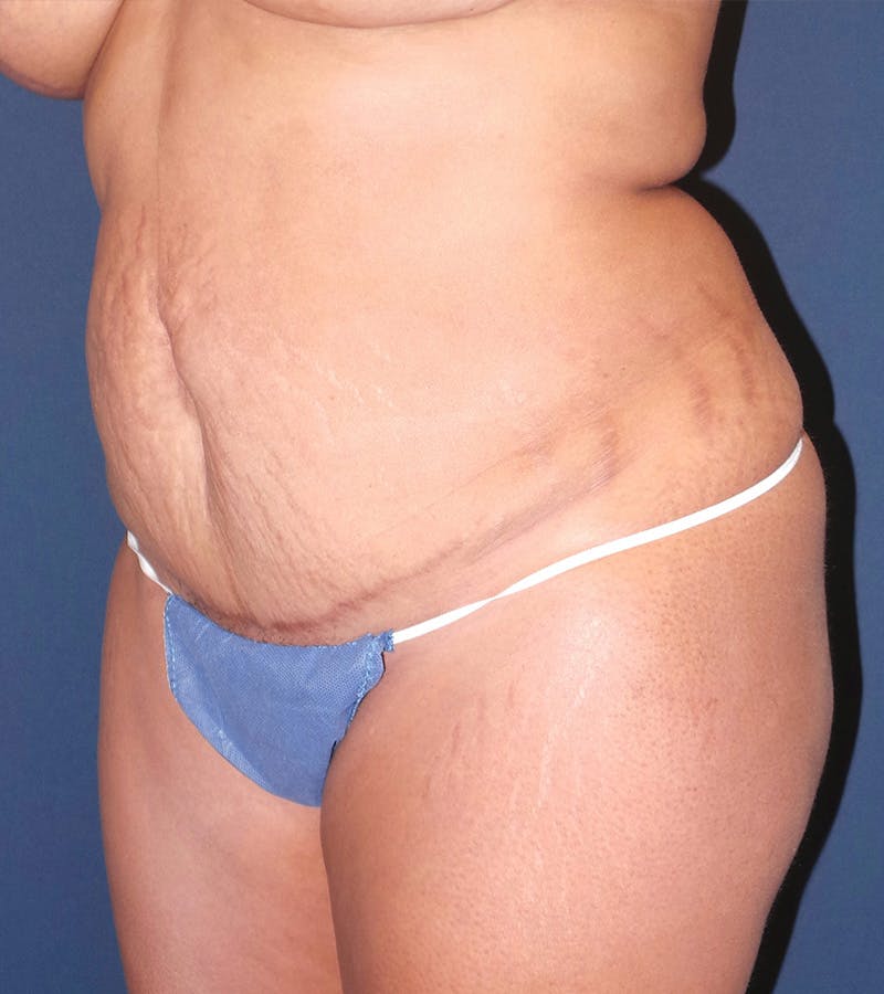 Liposuction by Dr. Booth Before & After Gallery - Patient 195854419 - Image 5