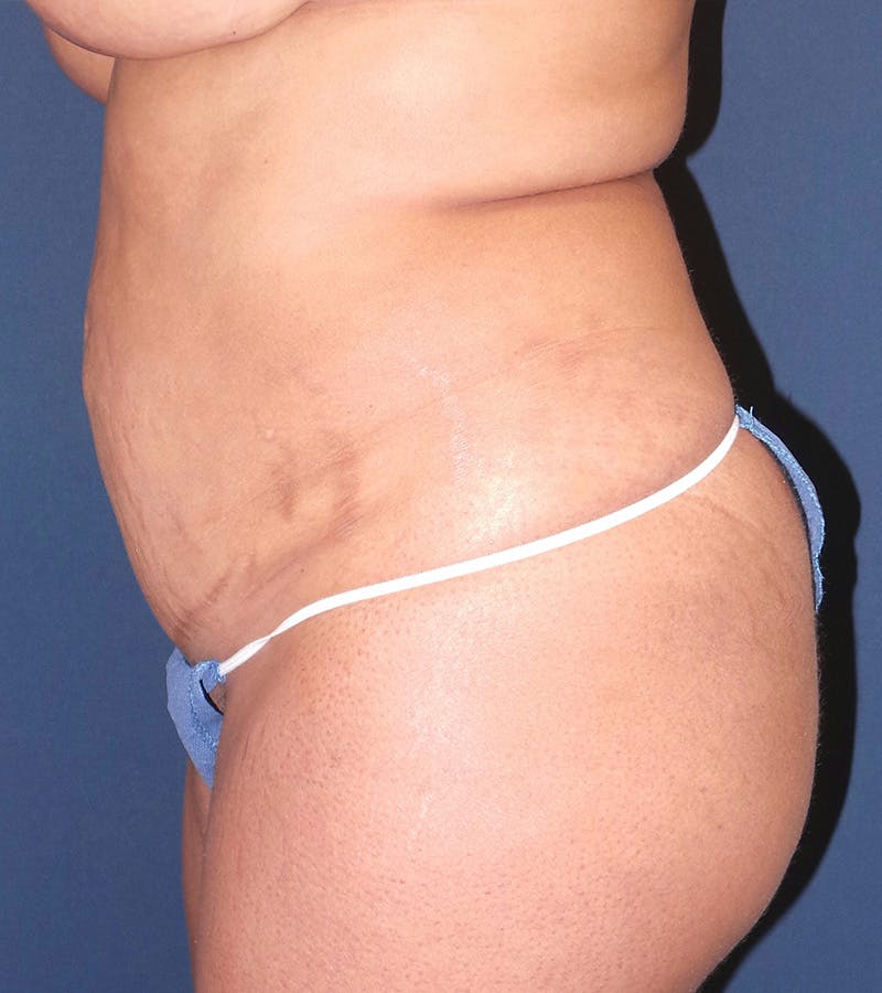 Liposuction by Dr. Booth Before & After Gallery - Patient 195854419 - Image 7
