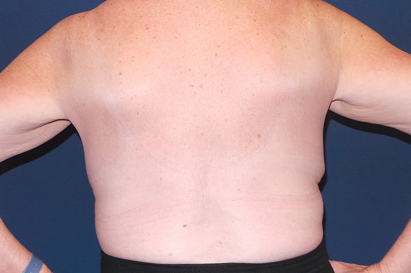 Upper Body Lift by Dr. Booth Before & After Gallery - Patient 197894284 - Image 1
