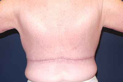 Upper Body Lift by Dr. Booth Before & After Gallery - Patient 197894284 - Image 2
