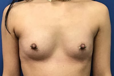 Breast Augmentation by Dr. Booth Before & After Gallery - Patient 197894163 - Image 1