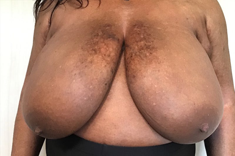 Breast Reduction by Dr. Booth Before & After Gallery - Patient 197894283 - Image 1