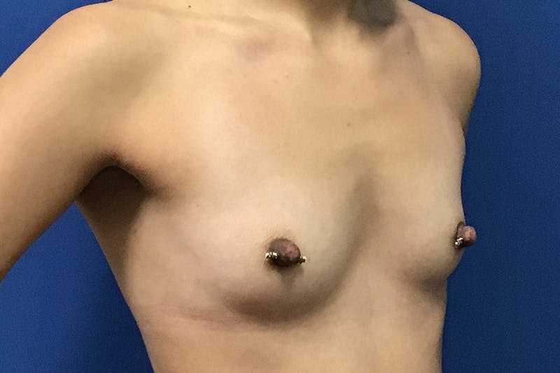 Breast Augmentation by Dr. Booth Before & After Gallery - Patient 197894163 - Image 3