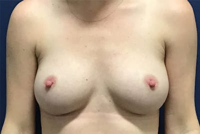 Breast Revision by Dr. Booth Before & After Gallery - Patient 197900057 - Image 1