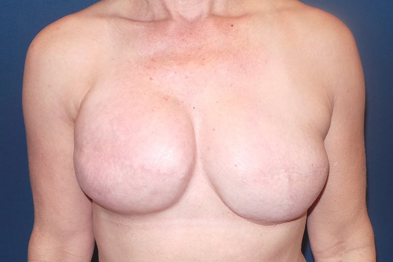 Breast Reconstruction by Dr. Booth Before & After Gallery - Patient 200114600 - Image 1