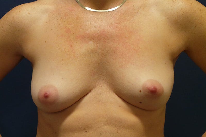 Breast Augmentation by Dr. Booth Before & After Gallery - Patient 200114787 - Image 1