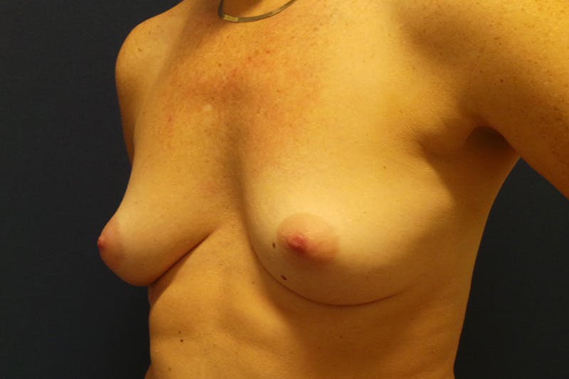 Breast Augmentation by Dr. Booth Before & After Gallery - Patient 200114787 - Image 5