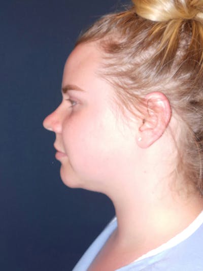 Submental Liposuction by Dr. Booth Before & After Gallery - Patient 206712984 - Image 1