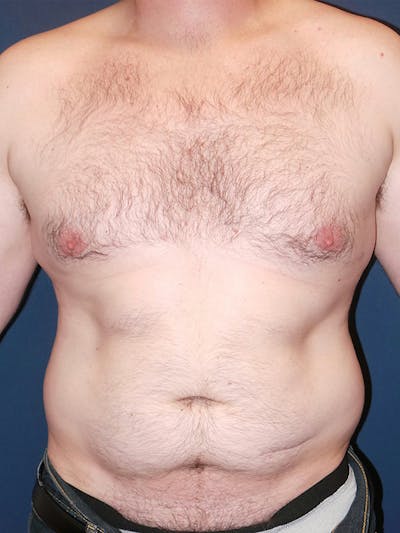 Liposuction by Dr. Booth Before & After Gallery - Patient 748293 - Image 1