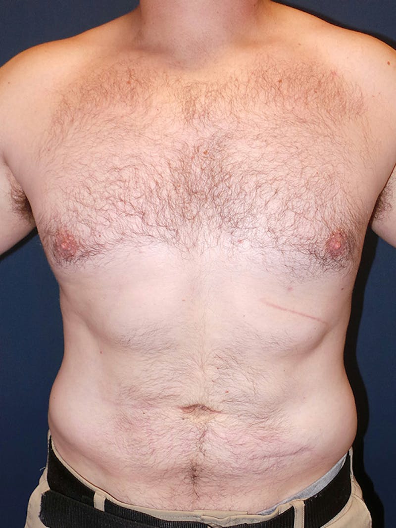 Lipo 360 by Dr. Booth Before & After Gallery - Patient 102012 - Image 2