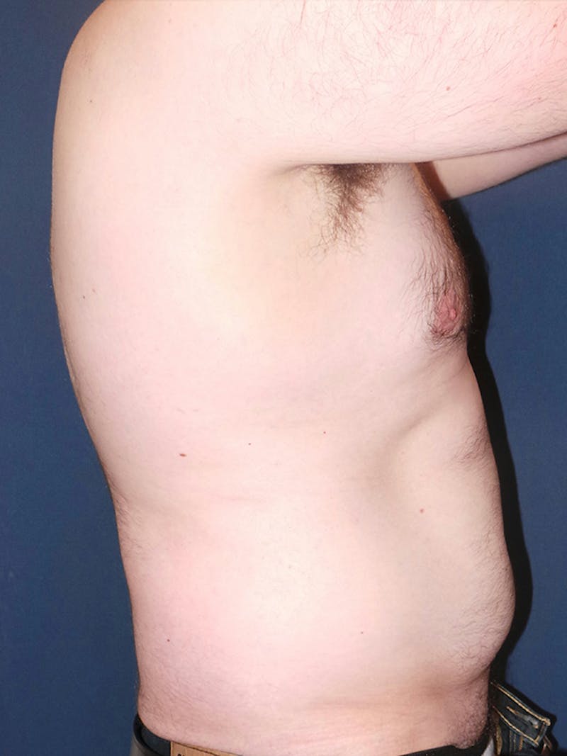 Lipo 360 by Dr. Booth Before & After Gallery - Patient 102012 - Image 3