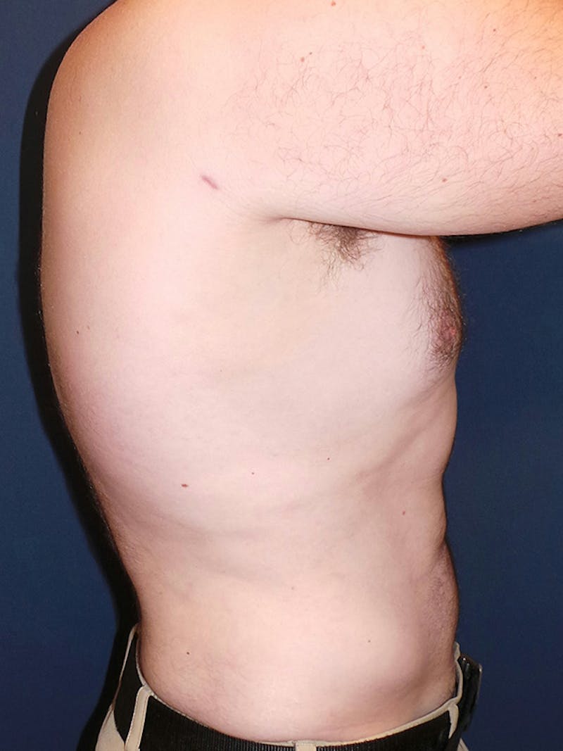 Lipo 360 by Dr. Booth Before & After Gallery - Patient 102012 - Image 4
