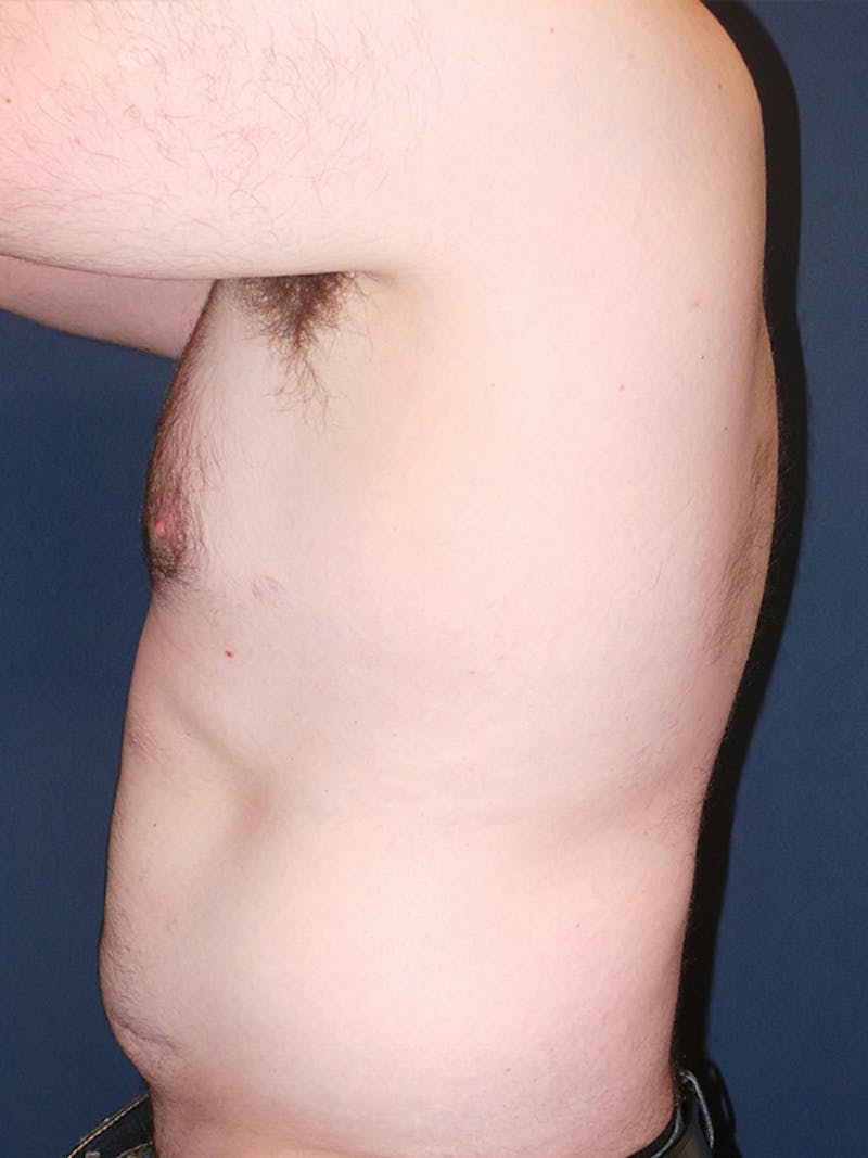 Liposuction by Dr. Booth Before & After Gallery - Patient 748293 - Image 5