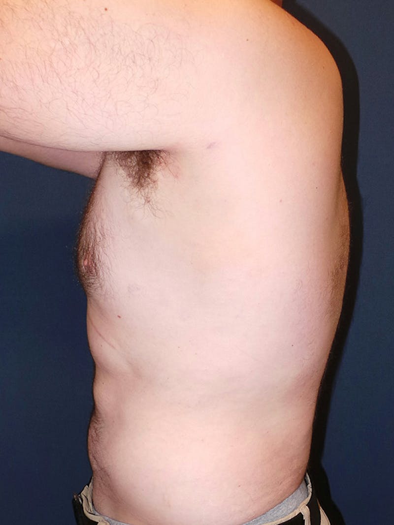 Liposuction by Dr. Booth Before & After Gallery - Patient 748293 - Image 6